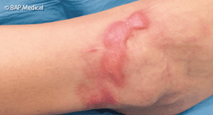 Keloïd litteken op de enkel, rood en verdikt, met actieve littekenvorming