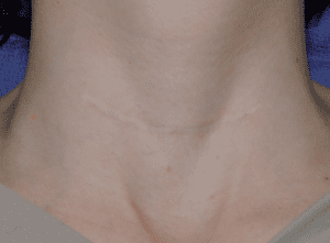 Volwassen litteken in de nek, licht van kleur en vlak, met uitgerijpt littekenweefsel